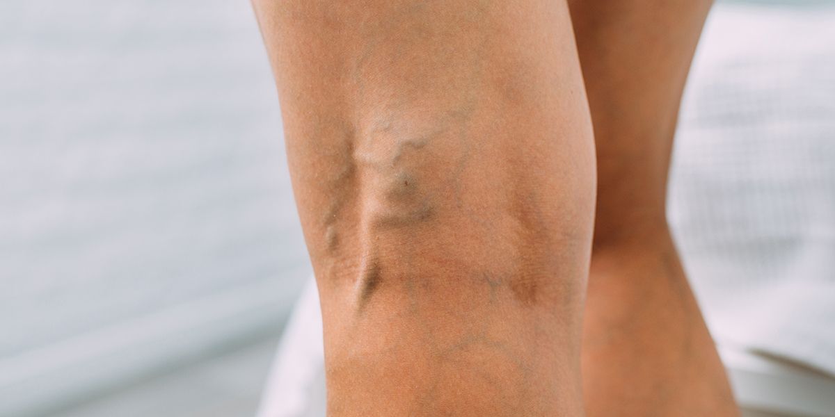 Varices : comprendre leurs origines et explorer les solutions efficaces