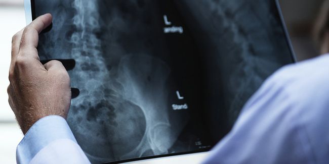Fracture du col du fémur : la chirurgie, solution incontournable ?